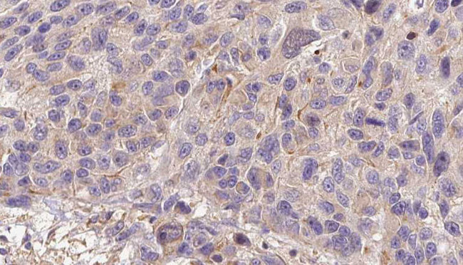 CFHR3 / CFHL3 Antibody - 1:100 staining human Melanoma tissue by IHC-P. The sample was formaldehyde fixed and a heat mediated antigen retrieval step in citrate buffer was performed. The sample was then blocked and incubated with the antibody for 1.5 hours at 22°C. An HRP conjugated goat anti-rabbit antibody was used as the secondary.