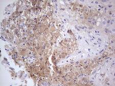 CFI / Complement Factor I Antibody - Immunohistochemical staining of paraffin-embedded Carcinoma of Human lung tissue using anti-CFI mouse monoclonal antibody.  Dilution: 1:150