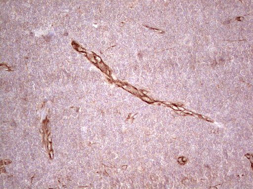 CFI / Complement Factor I Antibody - Immunohistochemical staining of paraffin-embedded Human lymphoma tissue using anti-CFI mouse monoclonal antibody. (Heat-induced epitope retrieval by 1 mM EDTA in 10mM Tris, pH8.5, 120C for 3min,