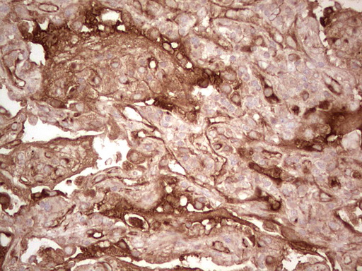 CFI / Complement Factor I Antibody - IHC of paraffin-embedded Carcinoma of Human lung tissue using anti-CFI mouse monoclonal antibody. (Heat-induced epitope retrieval by 1 mM EDTA in 10mM Tris, pH8.5, 120°C for 3min).