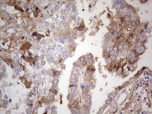 CFI / Complement Factor I Antibody - Immunohistochemical staining of paraffin-embedded Adenocarcinoma of Human ovary tissue using anti-CFI mouse monoclonal antibody.  Dilution: 1:150