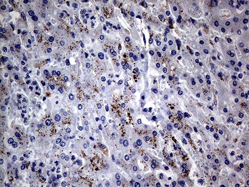CFI / Complement Factor I Antibody - Immunohistochemical staining of paraffin-embedded Carcinoma of Human liver tissue using anti-CFI mouse monoclonal antibody. (Heat-induced epitope retrieval by 1mM EDTA in 10mM Tris buffer. (pH8.5) at 120°C for 3 min. (1:2000)
