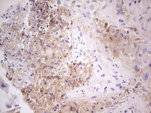 CFI / Complement Factor I Antibody - Immunohistochemical staining of paraffin-embedded Carcinoma of Human lung tissue using anti-CFI mouse monoclonal antibody.  Dilution: 1:150