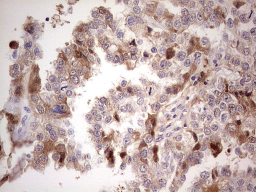 CFI / Complement Factor I Antibody - Immunohistochemical staining of paraffin-embedded Adenocarcinoma of Human ovary tissue using anti-CFI mouse monoclonal antibody.  Dilution: 1:150