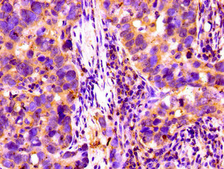 CFI / Complement Factor I Antibody - Immunohistochemistry image of paraffin-embedded human pancreatic cancer at a dilution of 1:100