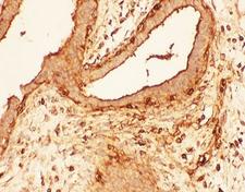 CFL1 / Cofilin Antibody - IHC-P: Cofilin antibody testing of human breast cancer tissue