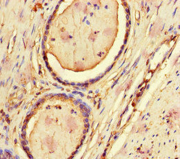 CFL1 / Cofilin Antibody - Immunohistochemistry of paraffin-embedded human prostate cancer at dilution of 1:100