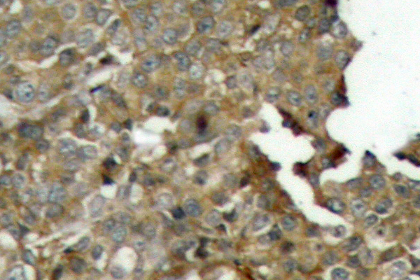 CFL1 / Cofilin Antibody - IHC of Cofilin (M1)pAb in paraffin-embedded human breast carcinoma tissue.