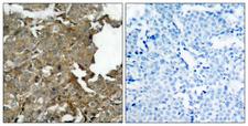 CFL1 / Cofilin Antibody - P-Peptide - + Immunohistochemical analysis of paraffin-embedded human breast carcinoma tissue using cofilin (Ab- 1022) antibody.