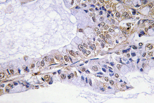 CFL1 / Cofilin Antibody - IHC of p-Cofilin (S3) pAb in paraffin-embedded human lung carcinoma tissue.