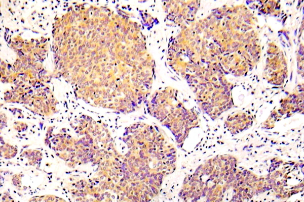 CFL1 / Cofilin Antibody - IHC of p-COFILN1 (S3) pAb in paraffin-embedded human lung adenocarcinoma tissue.