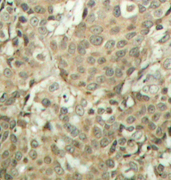 CFL1 / Cofilin Antibody - Immunohistochemical analysis of paraffin-embedded human breast carcinoma tissue.