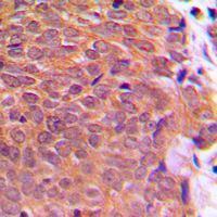 CFL1 / Cofilin Antibody - Immunohistochemical analysis of Cofilin (pS3) staining in human breast cancer formalin fixed paraffin embedded tissue section. The section was pre-treated using heat mediated antigen retrieval with sodium citrate buffer (pH 6.0). The section was then incubated with the antibody at room temperature and detected using an HRP conjugated compact polymer system. DAB was used as the chromogen. The section was then counterstained with hematoxylin and mounted with DPX.