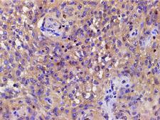 CFL1 / Cofilin Antibody - 1:200 staining human meningeal carcinomatosis(MC) tissue by IHC-P. The tissue was formaldehyde fixed and a heat mediated antigen retrieval step in citrate buffer was performed. The tissue was then blocked and incubated with the antibody for 1.5 hours at 22°C. An HRP conjugated goat anti-rabbit antibody was used as the secondary.