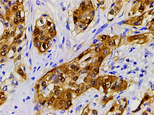 CFL1 / Cofilin Antibody - 1:200 staining human esophageal carcinoma tissue by IHC-P. The tissue was formaldehyde fixed and a heat mediated antigen retrieval step in citrate buffer was performed. The tissue was then blocked and incubated with the antibody for 1.5 hours at 22°C. An HRP conjugated goat anti-rabbit antibody was used as the secondary.