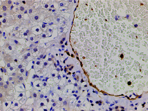 CFL1 / Cofilin Antibody - 1:200 staining human vascular carcinoma tissue by IHC-P. The tissue was formaldehyde fixed and a heat mediated antigen retrieval step in citrate buffer was performed. The tissue was then blocked and incubated with the antibody for 1.5 hours at 22°C. An HRP conjugated goat anti-rabbit antibody was used as the secondary.