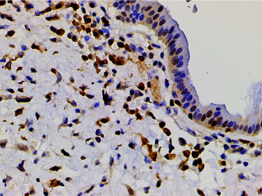 CFL1 / Cofilin Antibody - 1:200 staining human glioma tissue by IHC-P. The tissue was formaldehyde fixed and a heat mediated antigen retrieval step in citrate buffer was performed. The tissue was then blocked and incubated with the antibody for 1.5 hours at 22°C. An HRP conjugated goat anti-rabbit antibody was used as the secondary.