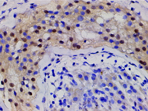 CFL1 / Cofilin Antibody - 1:200 staining human seminoma tissue by IHC-P. The tissue was formaldehyde fixed and a heat mediated antigen retrieval step in citrate buffer was performed. The tissue was then blocked and incubated with the antibody for 1.5 hours at 22°C. An HRP conjugated goat anti-rabbit antibody was used as the secondary.