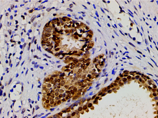 CFL1 / Cofilin Antibody - 1:200 staining human myosarcoma tissue by IHC-P. The tissue was formaldehyde fixed and a heat mediated antigen retrieval step in citrate buffer was performed. The tissue was then blocked and incubated with the antibody for 1.5 hours at 22°C. An HRP conjugated goat anti-rabbit antibody was used as the secondary.