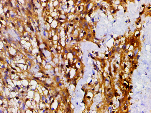 CFL1 / Cofilin Antibody - 1:200 staining human meningeal carcinomatosis(MC) tissue by IHC-P. The tissue was formaldehyde fixed and a heat mediated antigen retrieval step in citrate buffer was performed. The tissue was then blocked and incubated with the antibody for 1.5 hours at 22°C. An HRP conjugated goat anti-rabbit antibody was used as the secondary.
