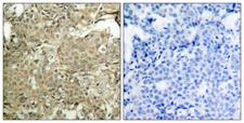 CFL1 / Cofilin Antibody - P-Peptide - + Immunohistochemical analysis of paraffin-embedded human breast carcinoma tissue using cofilin (phospho-Ser3) antibody.