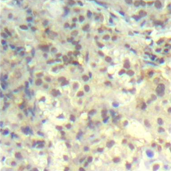 CFL1 / Cofilin Antibody - Immunohistochemical analysis of paraffin-embedded human lung carcinoma tissue.