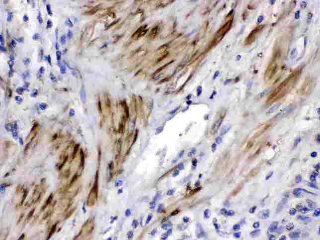 CFL2 / Cofilin 2 Antibody - Cofilin 2 was detected in paraffin-embedded sections of human prostatic cancer tissues using rabbit anti- Cofilin 2 Antigen Affinity purified polyclonal antibody