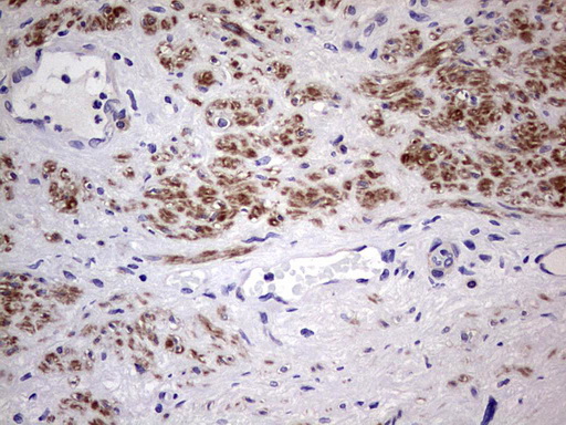 CFLAR / FLIP Antibody - Immunohistochemical staining of paraffin-embedded Carcinoma of Human prostate tissue using anti-CFLAR mouse monoclonal antibody. (Heat-induced epitope retrieval by 1 mM EDTA in 10mM Tris, pH8.5, 120C for 3min,