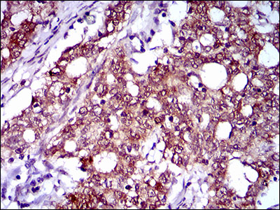 CFLAR / FLIP Antibody - IHC of paraffin-embedded cervical cancer tissues using CFLAR mouse monoclonal antibody with DAB staining.