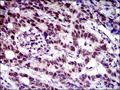 CFLAR / FLIP Antibody - IHC of paraffin-embedded esophageal cancer tissues using CFLAR mouse monoclonal antibody with DAB staining.