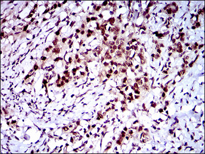 CFLAR / FLIP Antibody - IHC of paraffin-embedded cervical cancer tissues using CFLAR mouse monoclonal antibody with DAB staining.