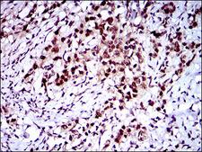 CFLAR / FLIP Antibody - IHC of paraffin-embedded cervical cancer tissues using CFLAR mouse monoclonal antibody with DAB staining.