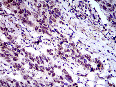 CFLAR / FLIP Antibody - IHC of paraffin-embedded esophagus cancer tissues using CFLAR mouse monoclonal antibody with DAB staining.