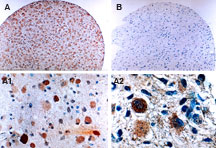 CFLAR / FLIP Antibody - IHC of FLIP in two tissues cores from a formalin-fixed, paraffin-embedded human brain tumor microarray using Polyclonal Antibody to FLIP (long and short) at 1:2000. A, gemistocytoma (Grade II) positive for FLIP expression. B, gemistocytoma (Grade II) negative for FLIP expression. A1 and A2 are higher magnifications from A. A, A1, and A2 show expression of FLIP in the gemistocytes of the tumor. Hematoxylin-Eosin counterstain.