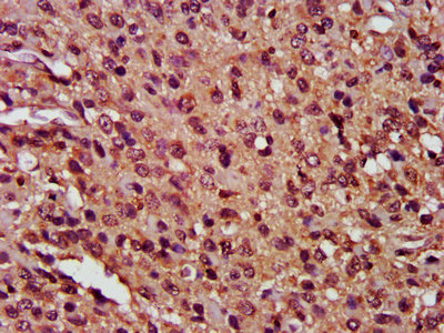 CFLAR / FLIP Antibody - IHC image of CFLAR Antibody diluted at 1:400 and staining in paraffin-embedded human glioma performed on a Leica BondTM system. After dewaxing and hydration, antigen retrieval was mediated by high pressure in a citrate buffer (pH 6.0). Section was blocked with 10% normal goat serum 30min at RT. Then primary antibody (1% BSA) was incubated at 4°C overnight. The primary is detected by a biotinylated secondary antibody and visualized using an HRP conjugated SP system.