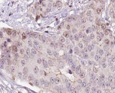 CGB / hCG Beta Antibody - 1:100 staining human liver carcinoma tissues by IHC-P. The tissue was formaldehyde fixed and a heat mediated antigen retrieval step in citrate buffer was performed. The tissue was then blocked and incubated with the antibody for 1.5 hours at 22°C. An HRP conjugated goat anti-rabbit antibody was used as the secondary.