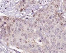 CGB / hCG Beta Antibody - 1:100 staining human liver carcinoma tissues by IHC-P. The tissue was formaldehyde fixed and a heat mediated antigen retrieval step in citrate buffer was performed. The tissue was then blocked and incubated with the antibody for 1.5 hours at 22°C. An HRP conjugated goat anti-rabbit antibody was used as the secondary.