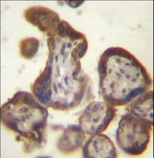 CGB / hCG Beta Antibody - CGB/HCG-Beta Antibody immunohistochemistry of formalin-fixed and paraffin-embedded human placenta tissue followed by peroxidase-conjugated secondary antibody and DAB staining.