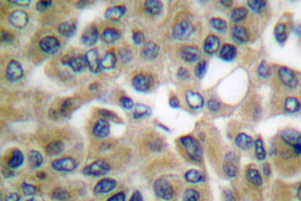 CGB / hCG Beta Antibody - IHC of hCG (D131) pAb in paraffin-embedded human breast carcinoma tissue.