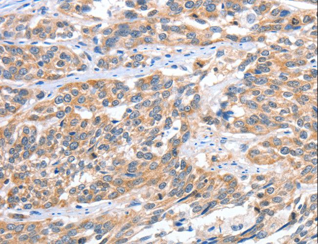 CGB / hCG Beta Antibody - Immunohistochemistry of paraffin-embedded Human ovarian cancer using CGB Polyclonal Antibody at dilution of 1:60.