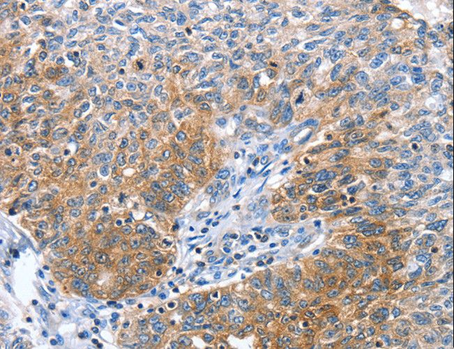 CGB / hCG Beta Antibody - Immunohistochemistry of paraffin-embedded Human ovarian cancer using CGB Polyclonal Antibody at dilution of 1:60.
