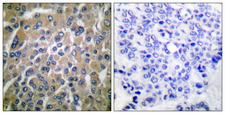 CGB / hCG Beta Antibody - Peptide - + Immunohistochemical analysis of paraffin-embedded human breast carcinoma tissue using hCG ß antibody.