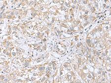 CGB5 Antibody - Immunohistochemistry of paraffin-embedded Human liver cancer tissue  using CGB5 Polyclonal Antibody at dilution of 1:55(×200)