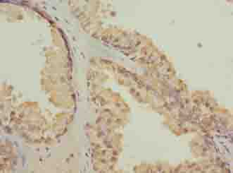 CGGBP1 Antibody - Immunohistochemistry of paraffin-embedded human prostate cancer using antibody at dilution of 1:100.
