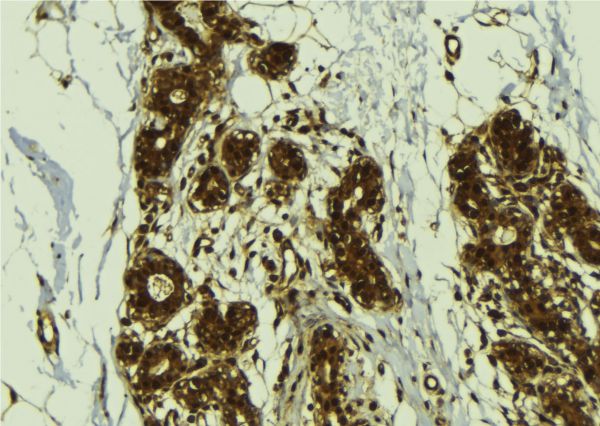 CGGBP1 Antibody - 1:100 staining human breast carcinoma tissue by IHC-P. The sample was formaldehyde fixed and a heat mediated antigen retrieval step in citrate buffer was performed. The sample was then blocked and incubated with the antibody for 1.5 hours at 22°C. An HRP conjugated goat anti-rabbit antibody was used as the secondary.