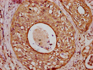 CGN / Cingulin Antibody - Immunohistochemistry Dilution at 1:800 and staining in paraffin-embedded human cervical cancer performed on a Leica BondTM system. After dewaxing and hydration, antigen retrieval was mediated by high pressure in a citrate buffer (pH 6.0). Section was blocked with 10% normal Goat serum 30min at RT. Then primary antibody (1% BSA) was incubated at 4°C overnight. The primary is detected by a biotinylated Secondary antibody and visualized using an HRP conjugated SP system.
