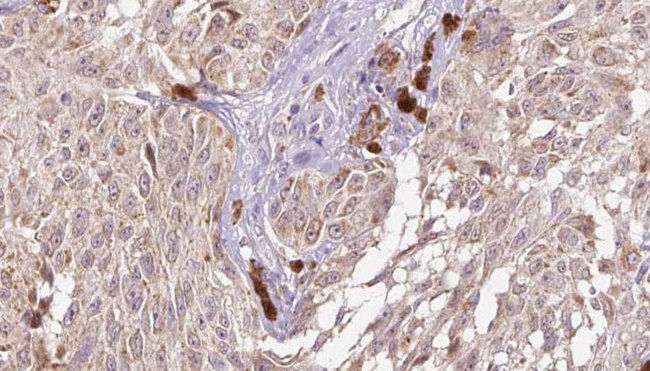 CGREF1 Antibody - 1:100 staining human Melanoma tissue by IHC-P. The sample was formaldehyde fixed and a heat mediated antigen retrieval step in citrate buffer was performed. The sample was then blocked and incubated with the antibody for 1.5 hours at 22°C. An HRP conjugated goat anti-rabbit antibody was used as the secondary.