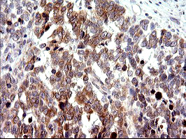 CHAC1 / MGC4504 Antibody - IHC of paraffin-embedded Adenocarcinoma of Human colon tissue using anti-CHAC1 mouse monoclonal antibody. (Heat-induced epitope retrieval by 10mM citric buffer, pH6.0, 120°C for 3min).