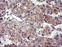 CHAC1 / MGC4504 Antibody - IHC of paraffin-embedded Carcinoma of Human liver tissue using anti-CHAC1 mouse monoclonal antibody. (Heat-induced epitope retrieval by 10mM citric buffer, pH6.0, 120°C for 3min).