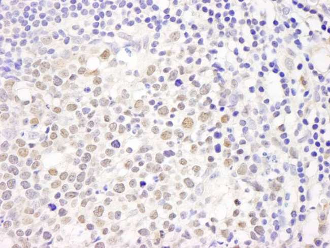 CHAF1A / CAF1 Antibody - Detection of Human Caf1p150 by Immunohistochemistry. Sample: FFPE section of human colon carcinoma Peyer's patch. Antibody: Affinity purified rabbit anti-Caf1p150 used at a dilution of 1:200 (1 ug/ml).
